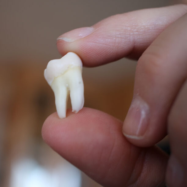 wisdom teeth removal by top oral surgeon