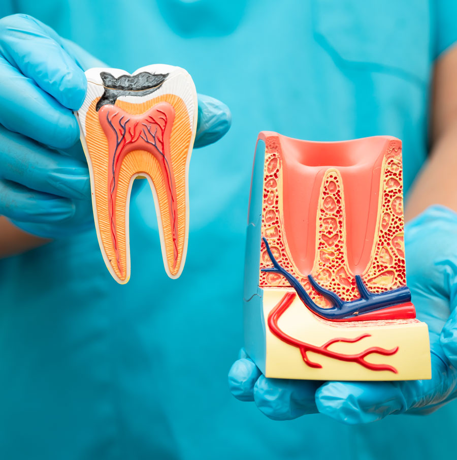 wisdom tooth extraction