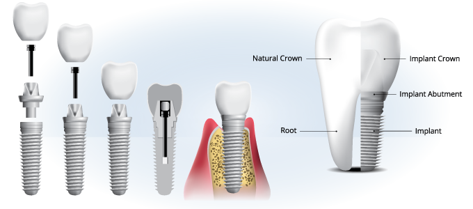 Dental Implants Structures