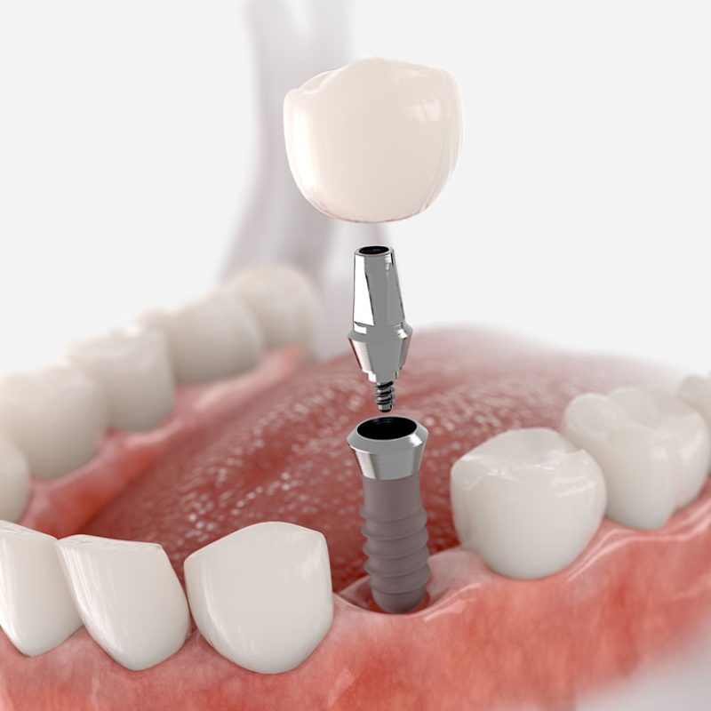 Implant crown on titanium post close-up