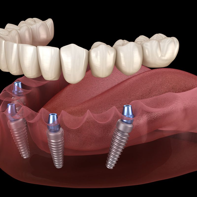All-on-4 full arch restoration model